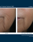 Skinbetter InterFuse Intensive Treatment LINES