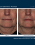 Skinbetter Interfuse Face and Neck