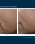 Skinbetter Interfuse Face and Neck
