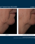 Skinbetter Interfuse Face and Neck