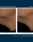 Skinbetter Interfuse Face and Neck