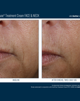Skinbetter Interfuse Face and Neck