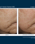 Skinbetter Interfuse Face and Neck