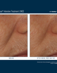 Skinbetter InterFuse Intensive Treatment LINES