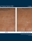 Skinbetter InterFuse Intensive Treatment LINES