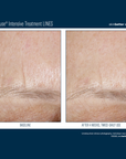 Skinbetter InterFuse Intensive Treatment LINES