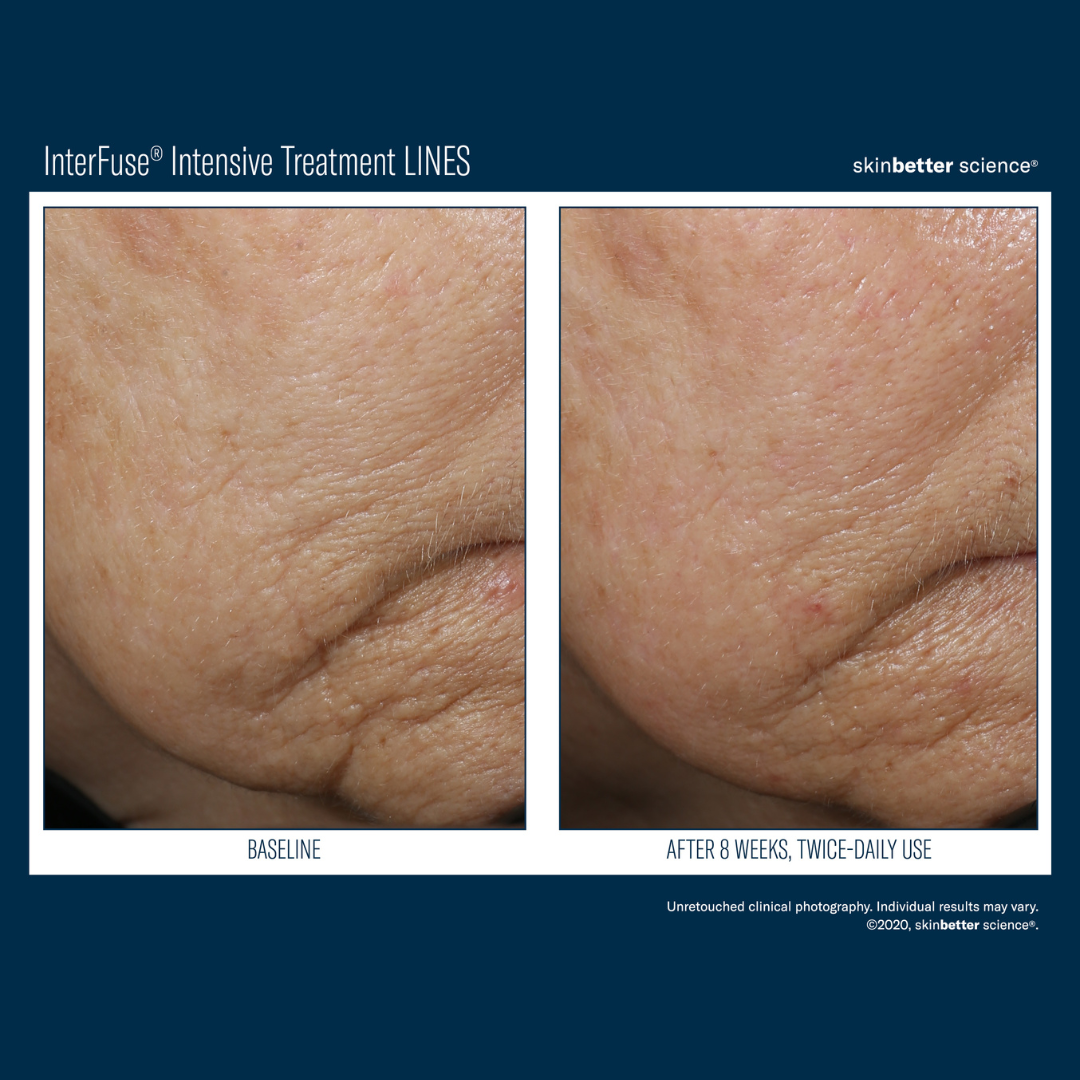 Skinbetter InterFuse Intensive Treatment LINES