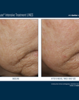 Skinbetter InterFuse Intensive Treatment LINES