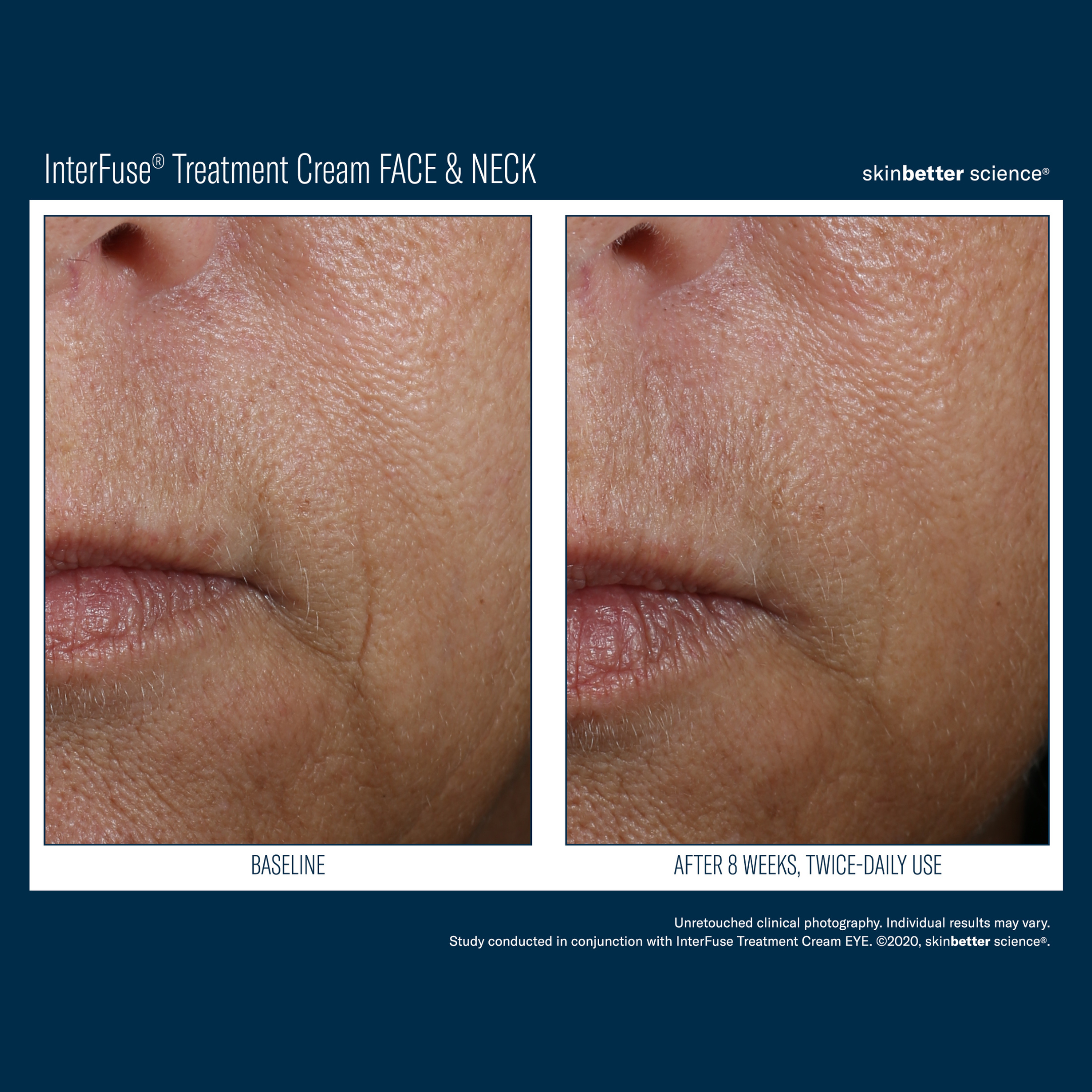 Skinbetter Interfuse Face and Neck