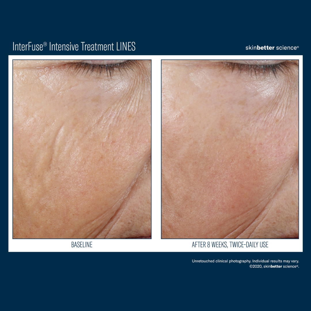Skinbetter InterFuse Intensive Treatment LINES