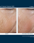 Skinbetter InterFuse Intensive Treatment LINES