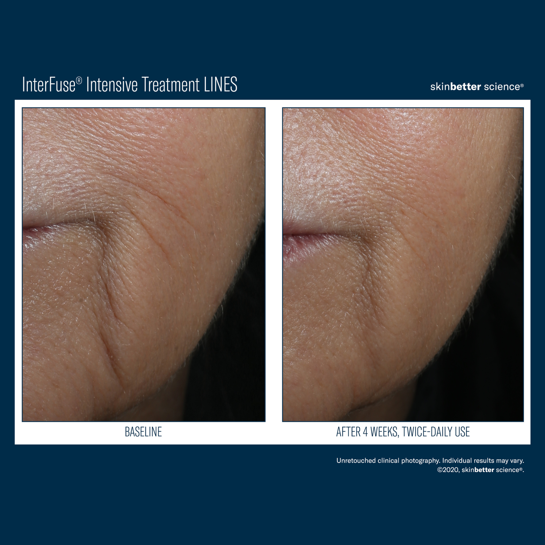 Skinbetter Interfuse Face and Neck