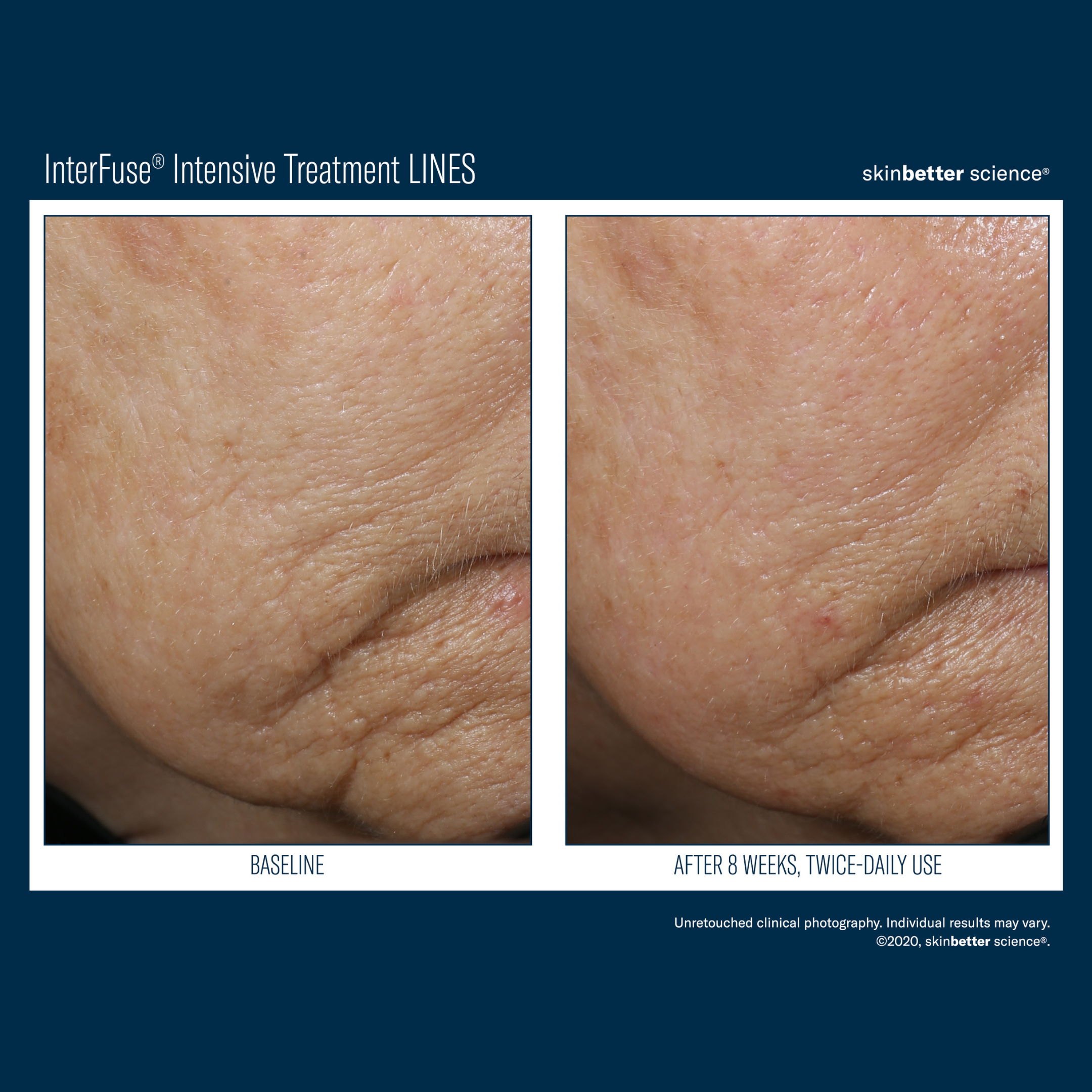 Skinbetter Interfuse Face and Neck