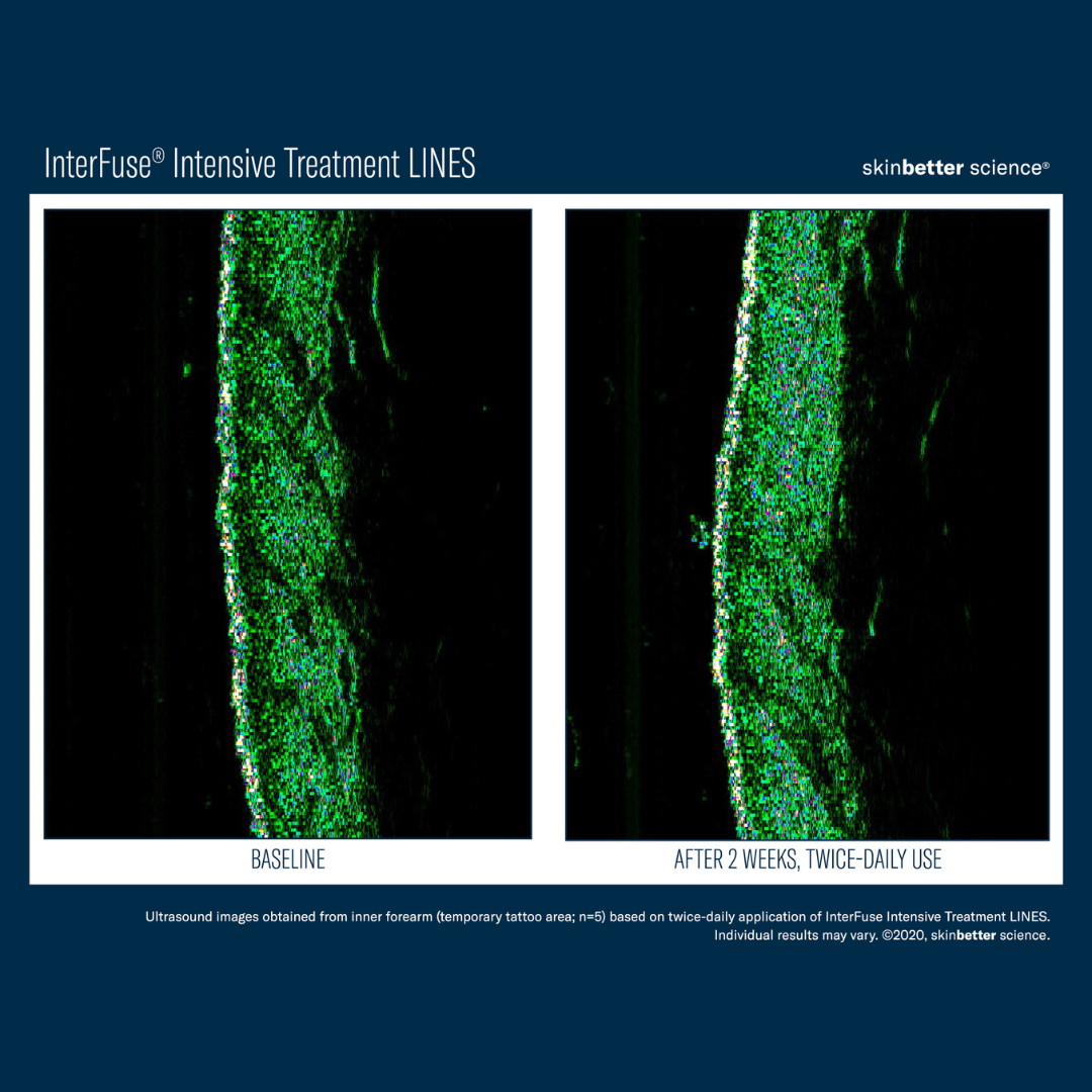 Skinbetter InterFuse Intensive Treatment LINES