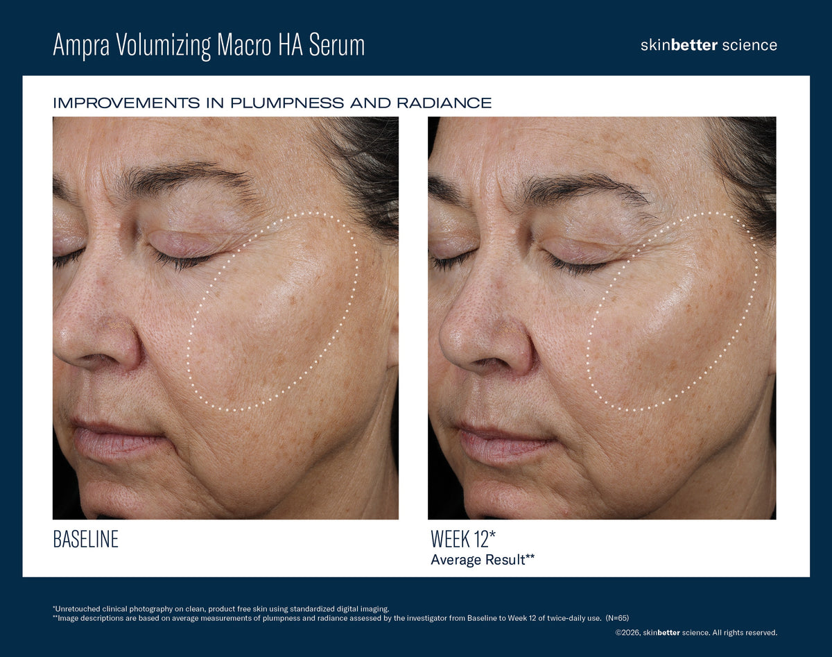 Before and after effects of Ampra Volumizing Macro HA Serum on skin plumpness and radiance.