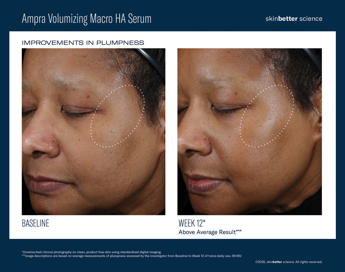 Before and after comparison of a woman's face with Ampra Volumizing Macro HA Serum showing improvements in plumpness.