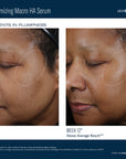 Before and after comparison of a woman's face with Ampra Volumizing Macro HA Serum showing improvements in plumpness.