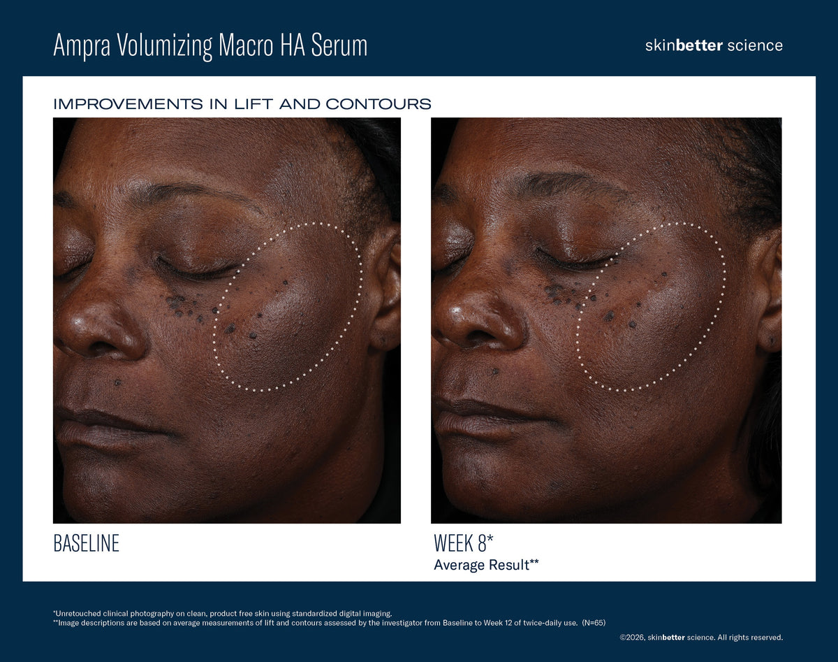 Before and after comparison of a woman's face with visible improvements in skin texture and contour using Ampra Volumizing Macro HA Serum.