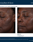Before and after comparison of a woman's face with visible improvements in skin texture and contour using Ampra Volumizing Macro HA Serum.