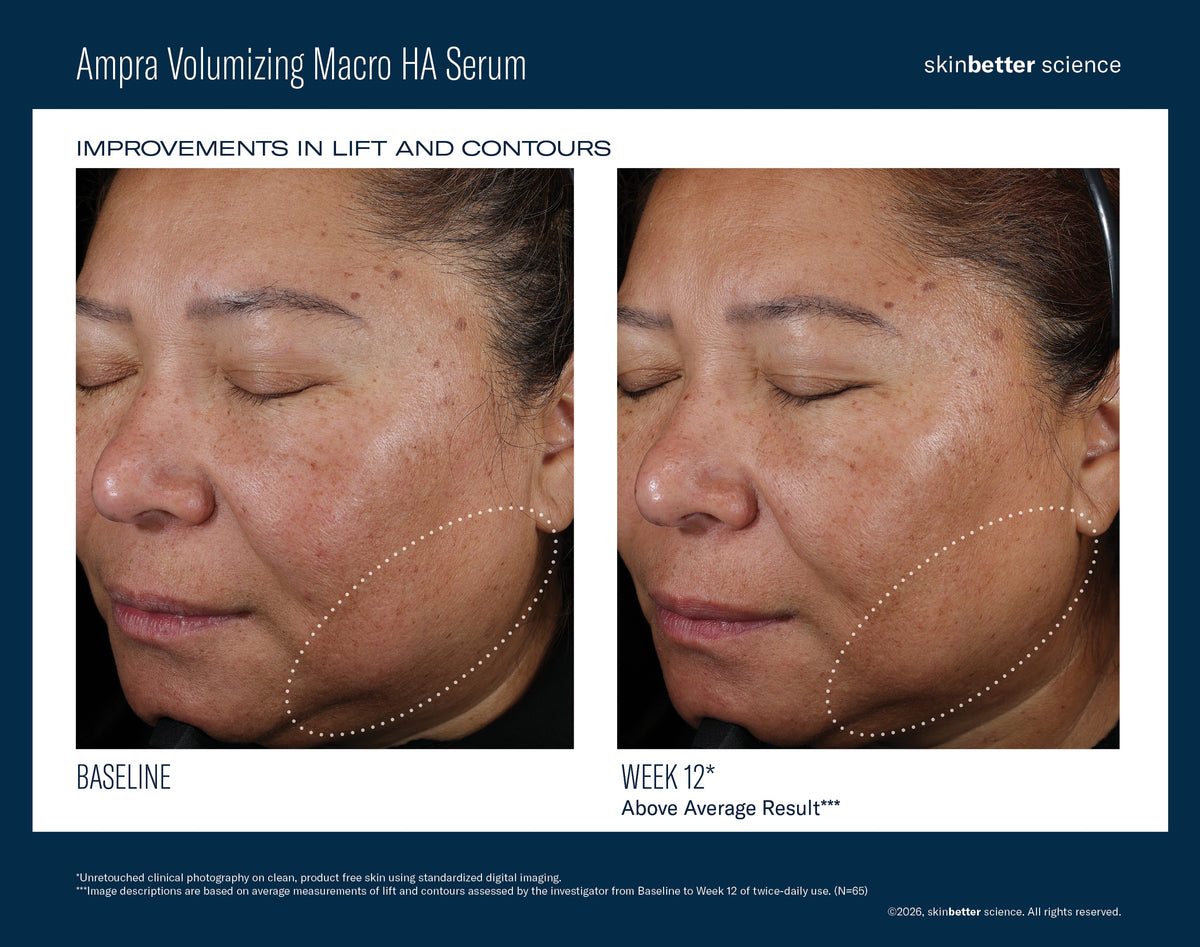 Before and after effects of Ampra Volumizing Macro HA Serum on a woman's face, showing improvements in lift and contours.