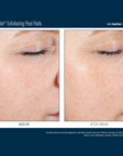Skinbetter Alpharet Peel Pads 30ct