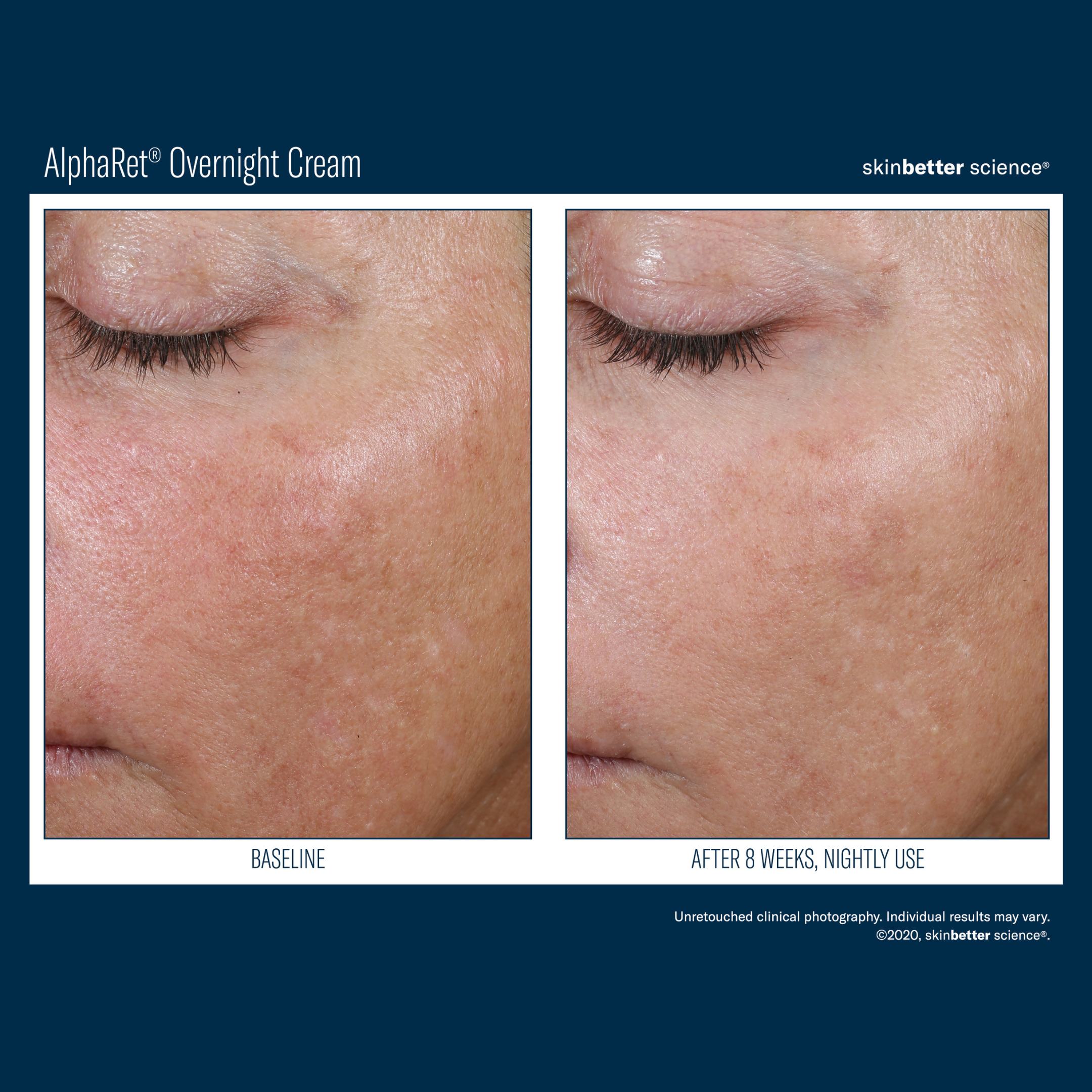 Skinbetter Alpharet Overnight Cream