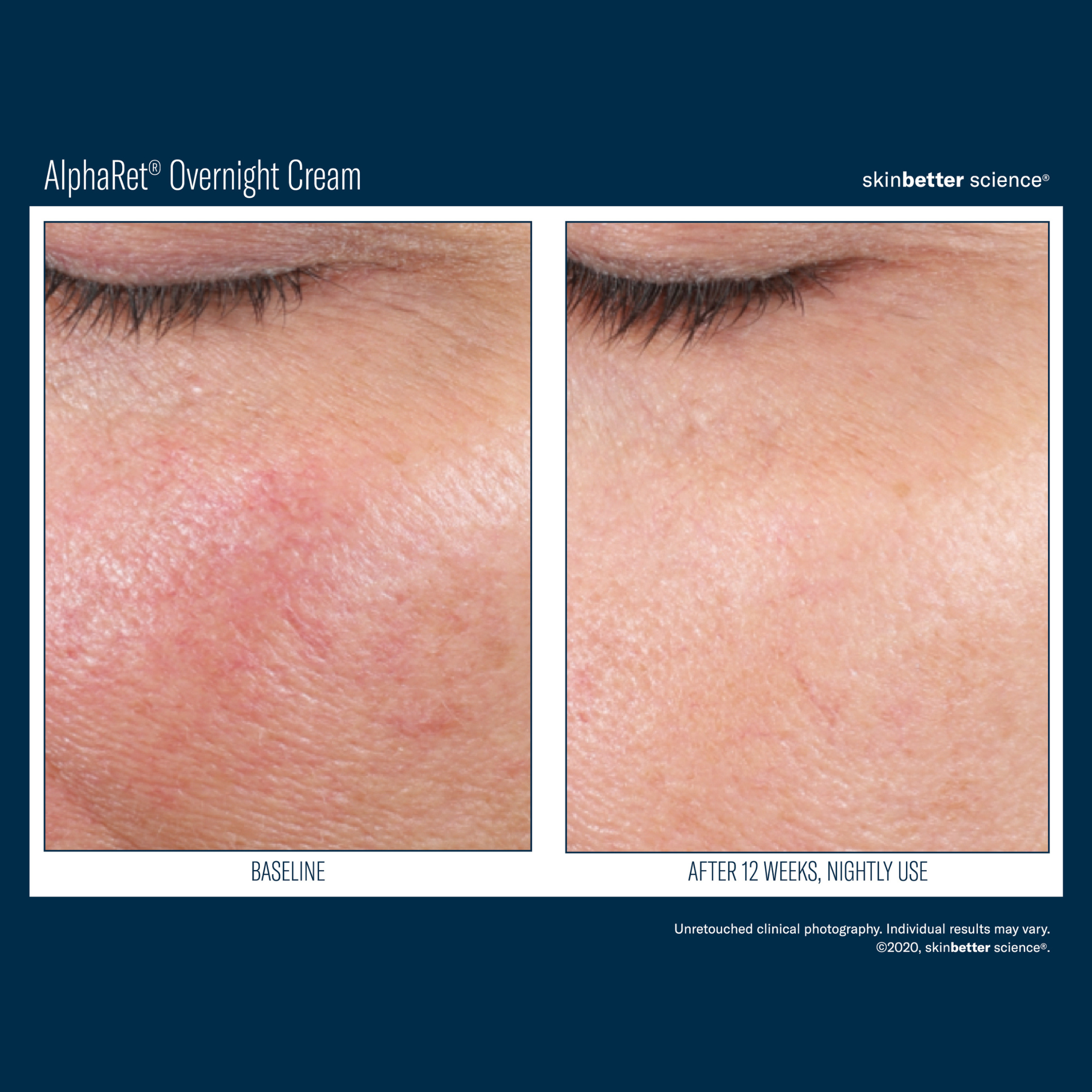 Skinbetter Alpharet Overnight Cream