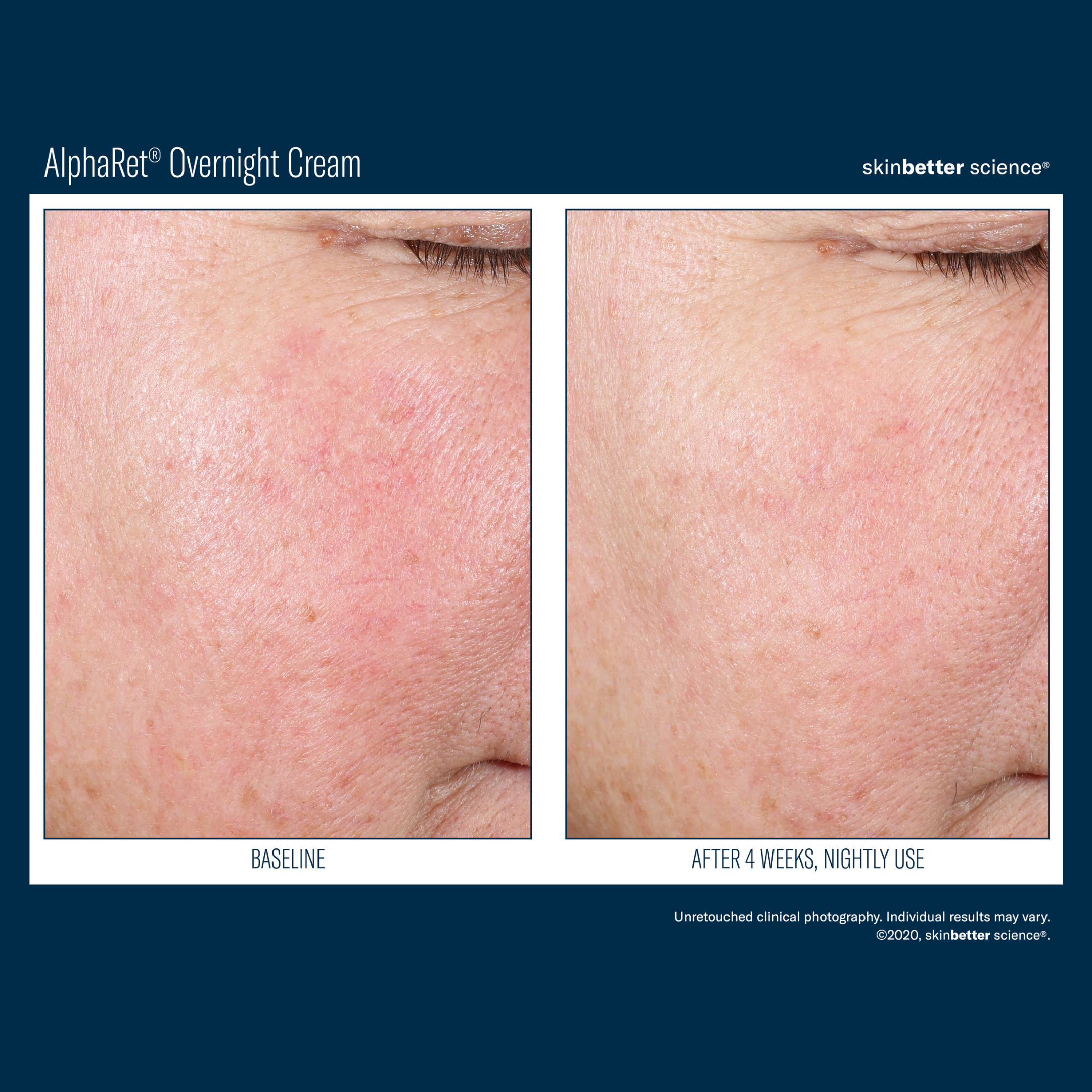 Skinbetter Alpharet Overnight Cream