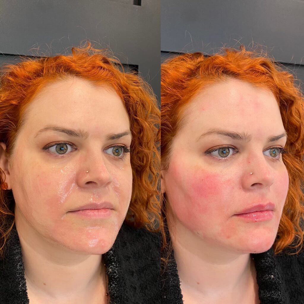 Female Facial Balancing Before & After Photos | SavvyDerm Skin Clinic in Millville, DE