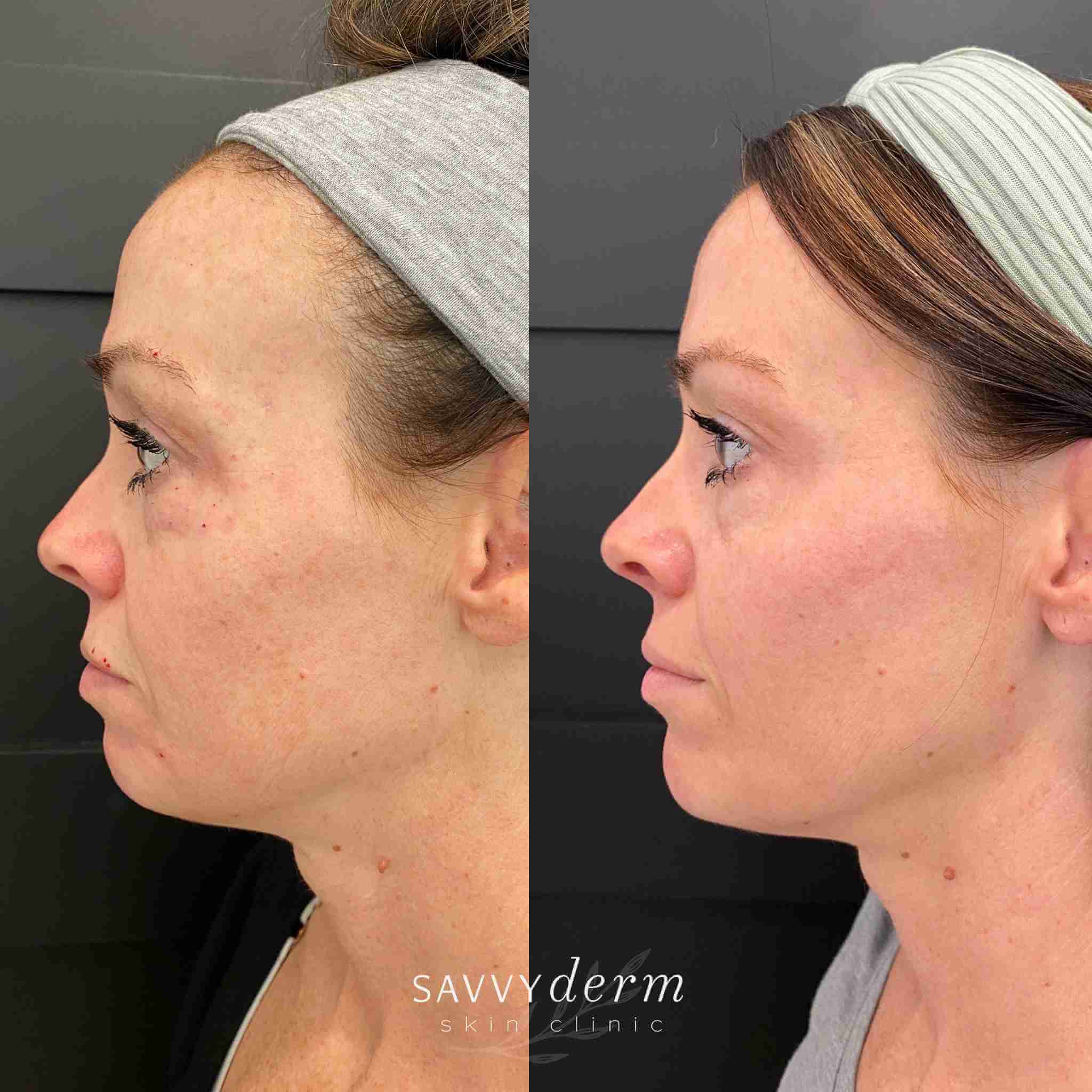 Woman Facial Balancing Before & After Photos | SavvyDerm Skin Clinic in Millville, DE