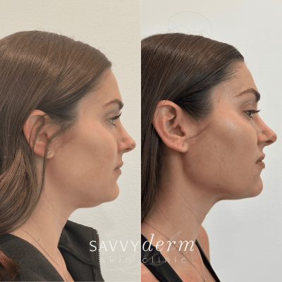 Before and After Sculptra (1)