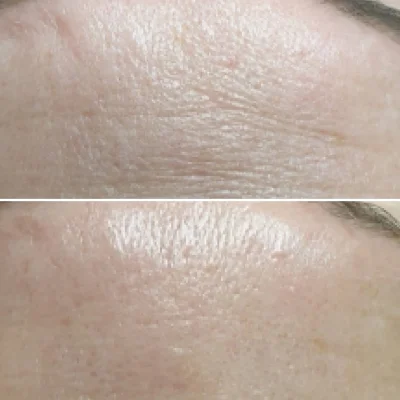 Biorepeel Treatment by SavvyDerm in Millville DE