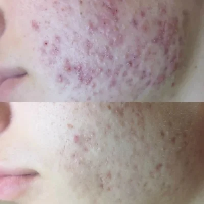 Biorepeel Treatment by SavvyDerm in Millville DE