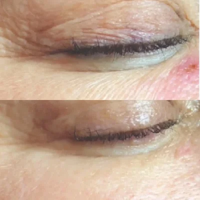 Biorepeel Treatment by SavvyDerm in Millville DE