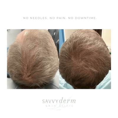 Hair Growth Treatment at SavvyDerm in Millville DE