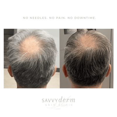 Hair Growth Treatment at SavvyDerm in Millville DE