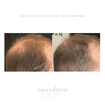 Hair Growth Treatment at SavvyDerm in Millville DE