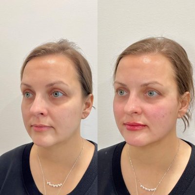Female Facial Balancing Before & After Photos | SavvyDerm Skin Clinic in Millville, DE