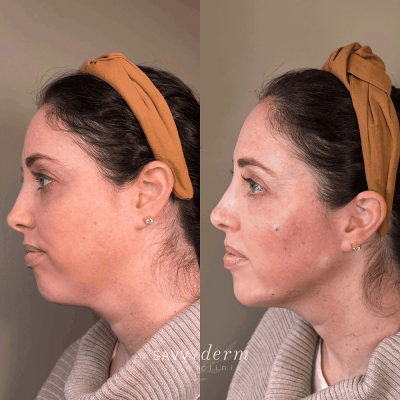 Facial Balancing Before & After Photos | SavvyDerm Skin Clinic in Millville, DE