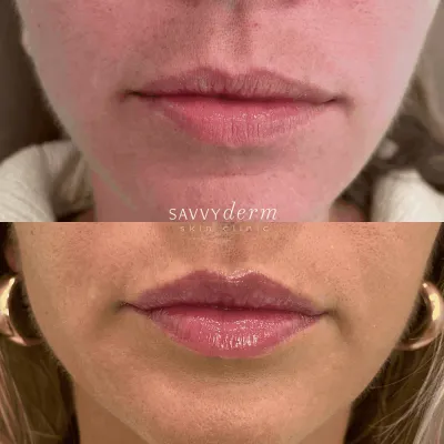 Female Facial Balancing Before & After Photos | SavvyDerm Skin Clinic in Millville, DE