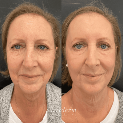 Female Laser Treatment Before & After Photos | SavvyDerm Skin Clinic in Millville, DE