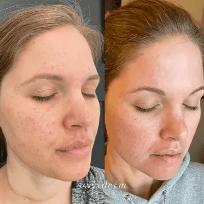 Female Laser Treatment Before & After Photos | SavvyDerm Skin Clinic in Millville, DE