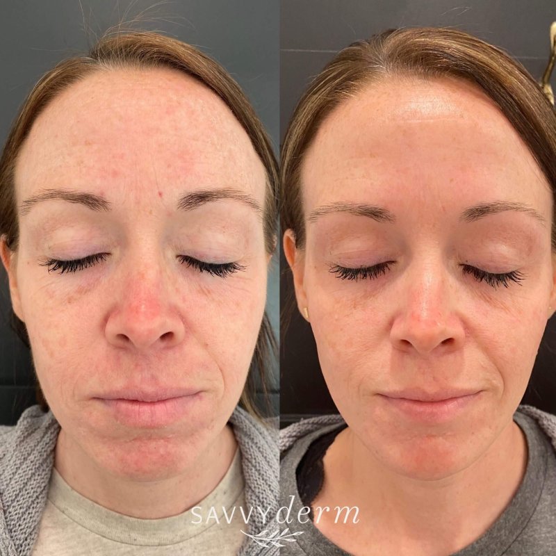 Female Microneedling Before & After Photos | SavvyDerm Skin Clinic in Millville, DE