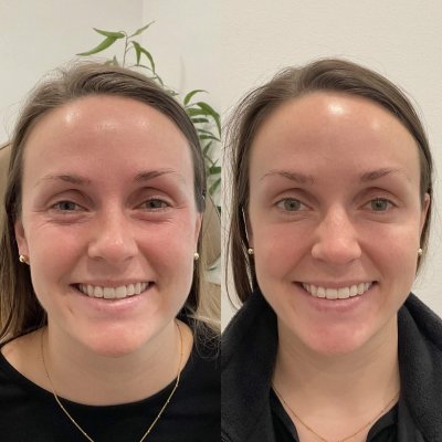 Female neurotoxin Before & After Photos | SavvyDerm Skin Clinic in Millville, DE