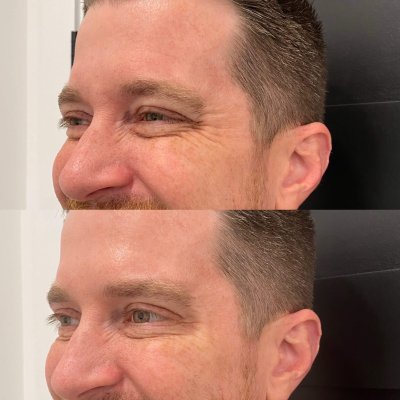 Male Botox Before & After Photos | SavvyDerm Skin Clinic in Millville, DE