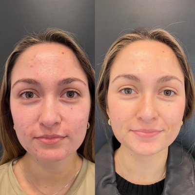 Chemical Peels Treatment Before & After Photos | SavvyDerm Skin Clinic in Millville, DE