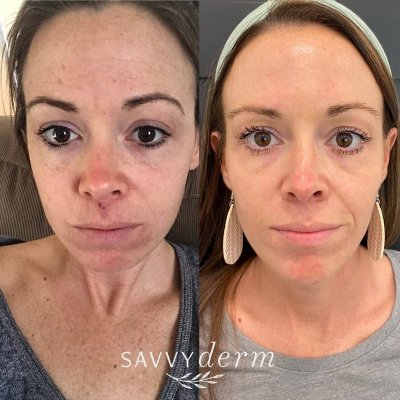 Female Before & After Skincare Consult Photos | SavvyDerm Skin Clinic in Millville, DE