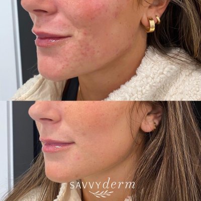 Female Skincare Consult Before & After Photos | SavvyDerm Skin Clinic in Millville, DE